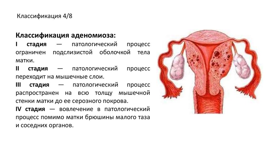Чем лечить эндометриоз матки у женщин. Эндометриоз классификация аденомиоза. Эндометриоз тела матки (аденомиоз). Аденомиоз миометрия 2 степени. Аденомиоз тела матки 1 степени что это такое.