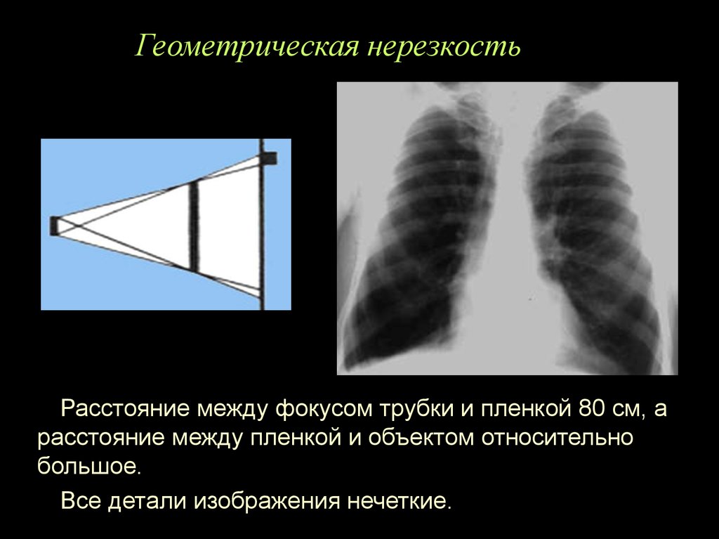 Нерезкость рентгеновского изображения