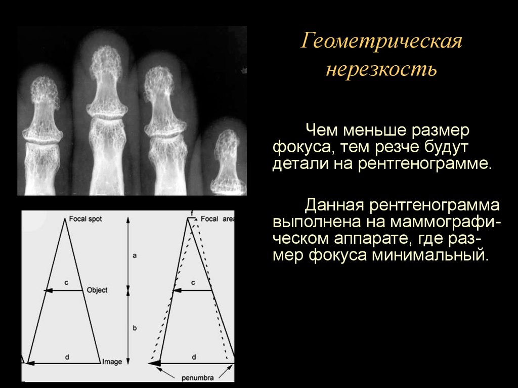 Нерезкость рентгеновского изображения