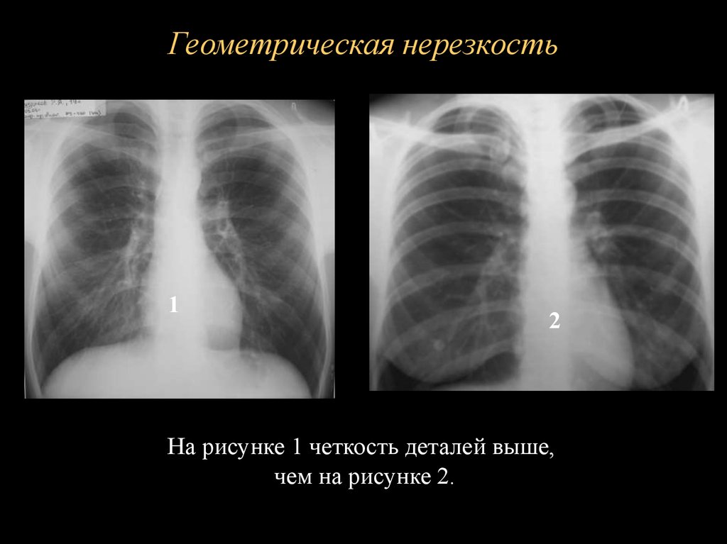 Нерезкость рентгеновского изображения