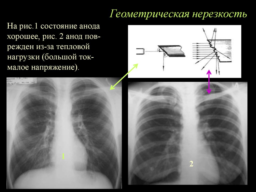 Нерезкость рентгеновского изображения