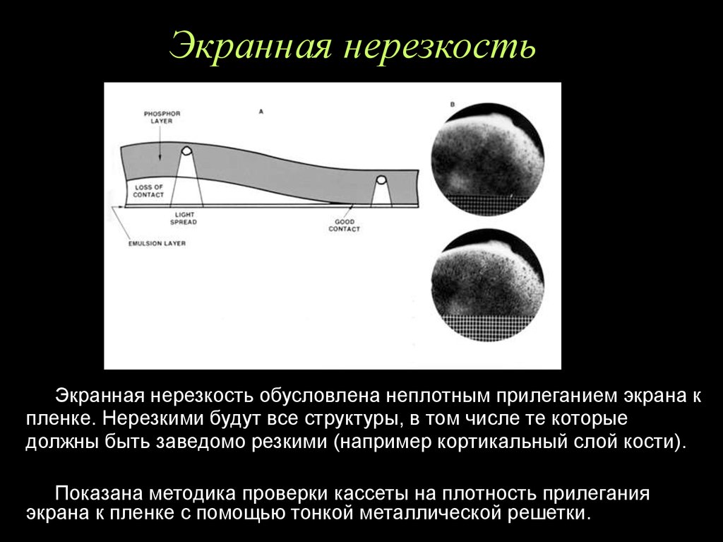 Нерезкость рентгеновского изображения