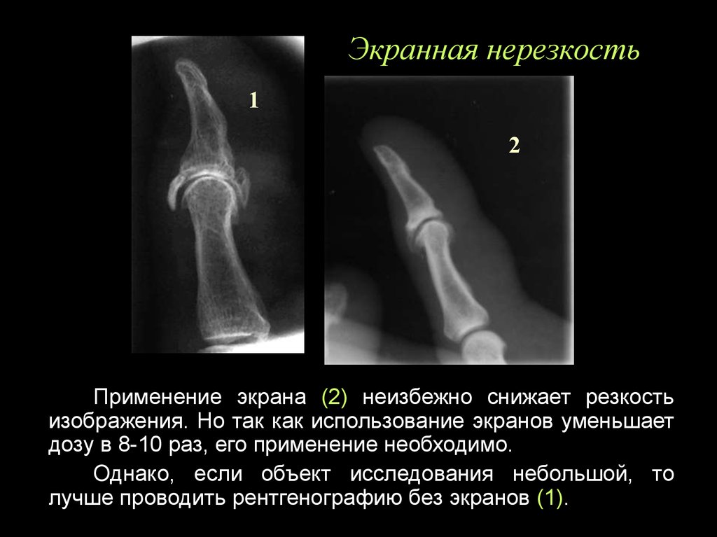 Нерезкость рентгеновского изображения