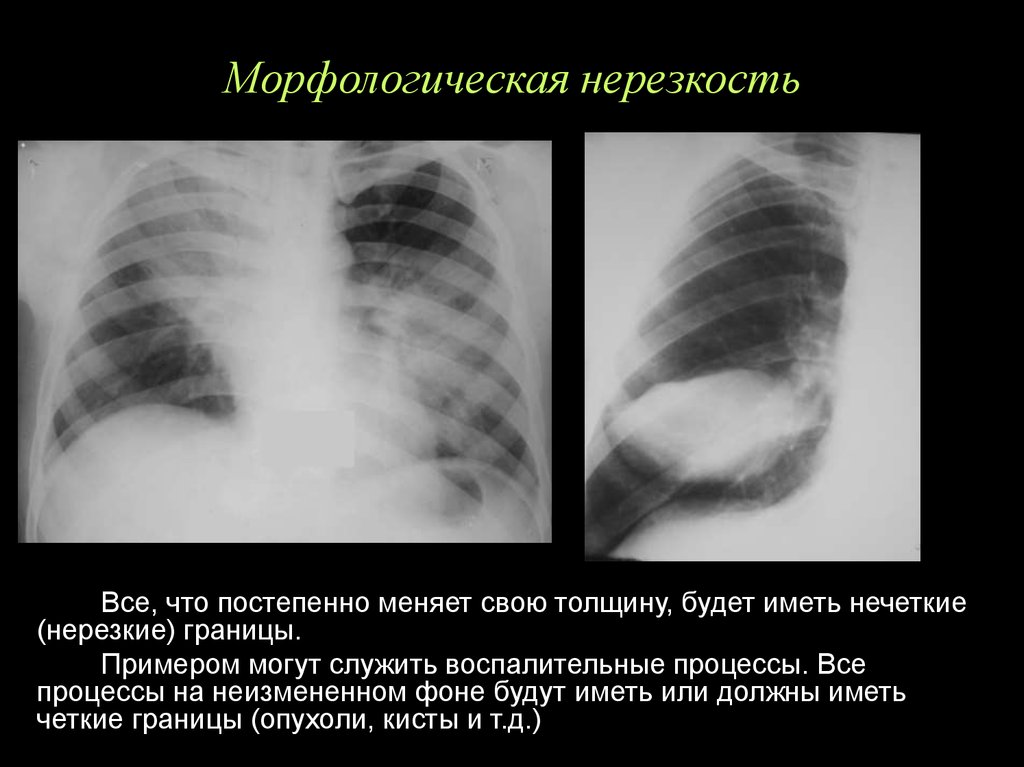 Геометрическая нерезкость рентгенограммы. Геометрическая нерезкость снимка. Геометрическая нерезкость рентгенограммы зависит от. Динамическая нерезкость на рентгене название.
