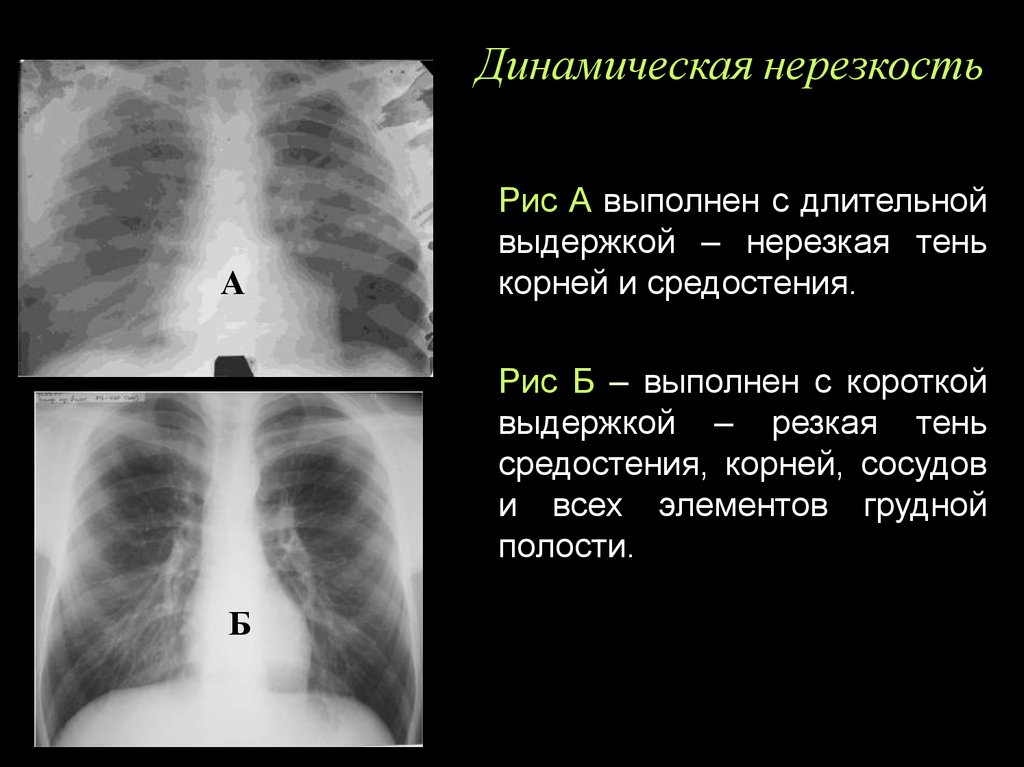 Нерезкость рентгеновского изображения