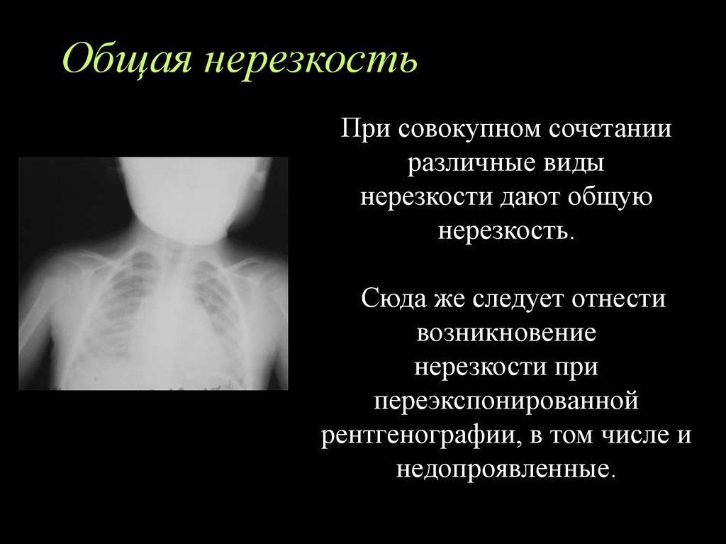 Нерезкость рентгеновского изображения