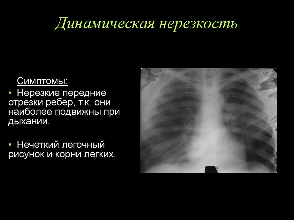 Нерезкость рентгеновского изображения