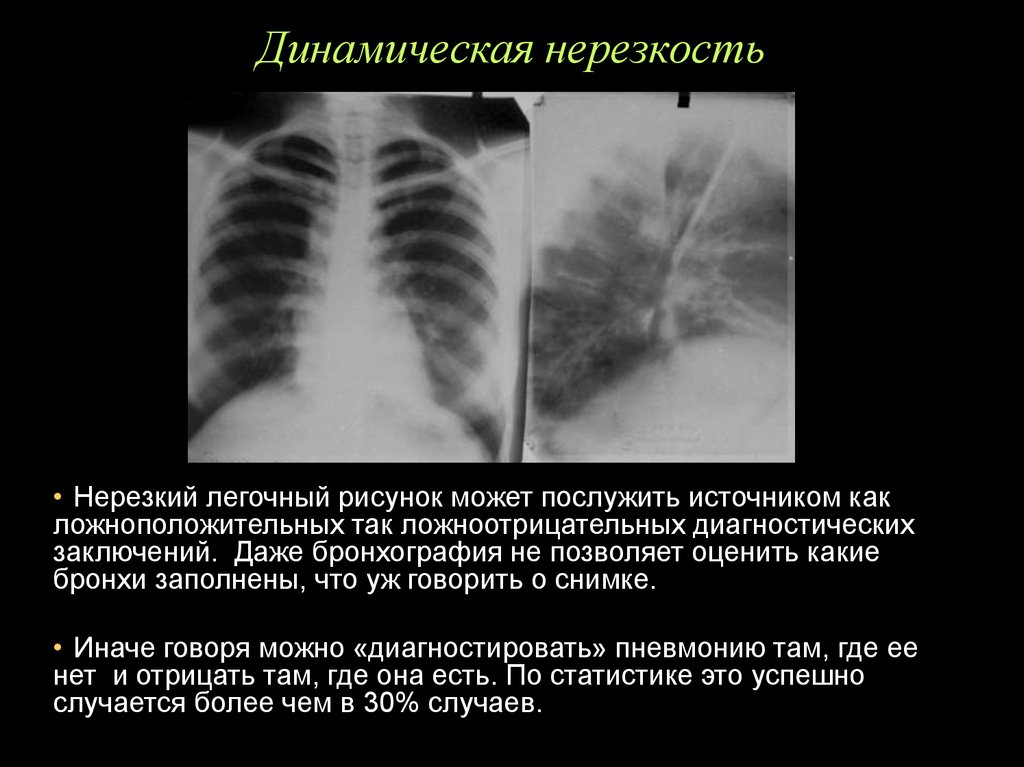 Нерезкость рентгеновского изображения