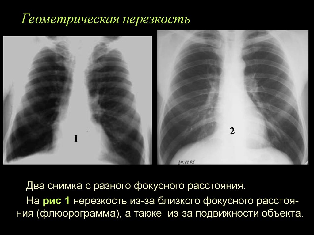 Два снимка. Резкость рентгенограммы. Динамическая нерезкость рентген. Контрастность рентген. Контрастность рентгеновского снимка легких.