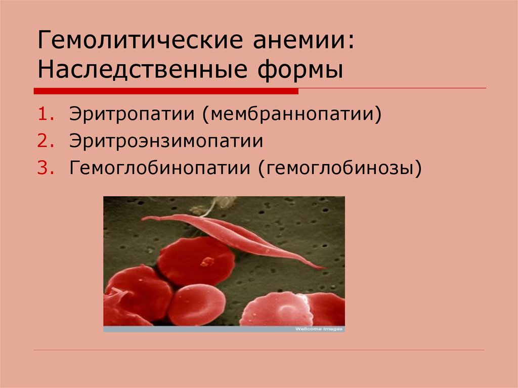Анемия гемолитического типа. Клинические проявления гемолитической анемии. Гемолиз эритроцитов при гемолитической анемии. Форма эритроцитов при гемолитической анемии. Кровь при наследственной гемолитической анемии.