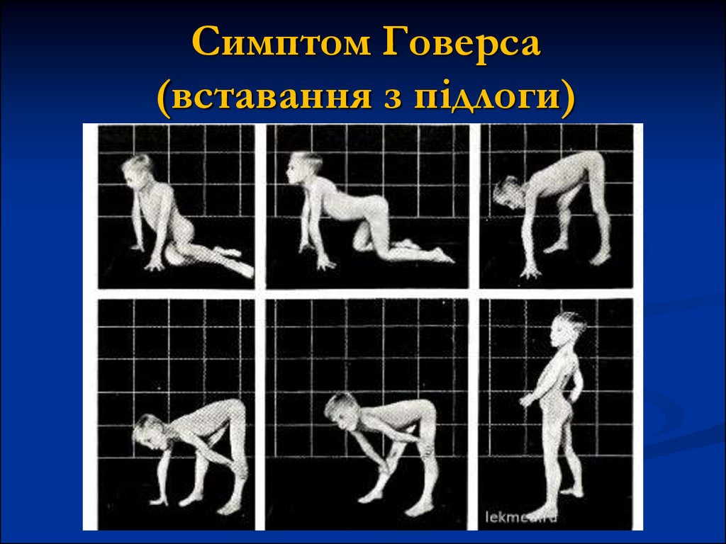 Миодистрофия дюшенна это. Симптом Говерса в неврологии. Приемы Говерса при вставании.