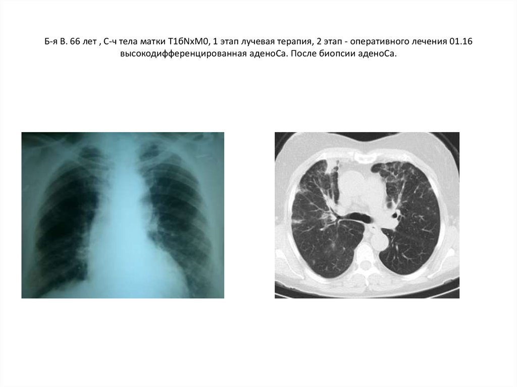 Б-я В. 66 лет , С-ч тела матки Т1бNxM0, 1 этап лучевая терапия, 2 этап - оперативного лечения 01.16 высокодифференцированная