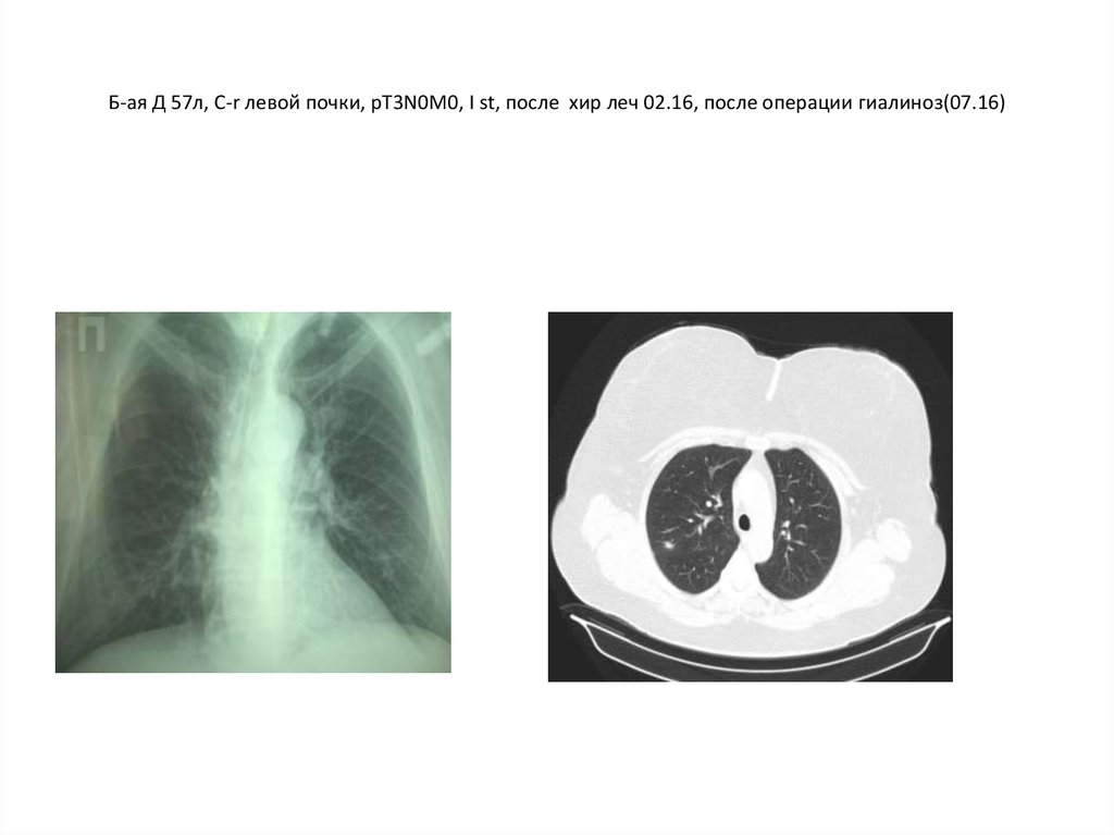Б-ая Д 57л, C-r левой почки, рТ3N0M0, I st, после хир леч 02.16, после операции гиалиноз(07.16)