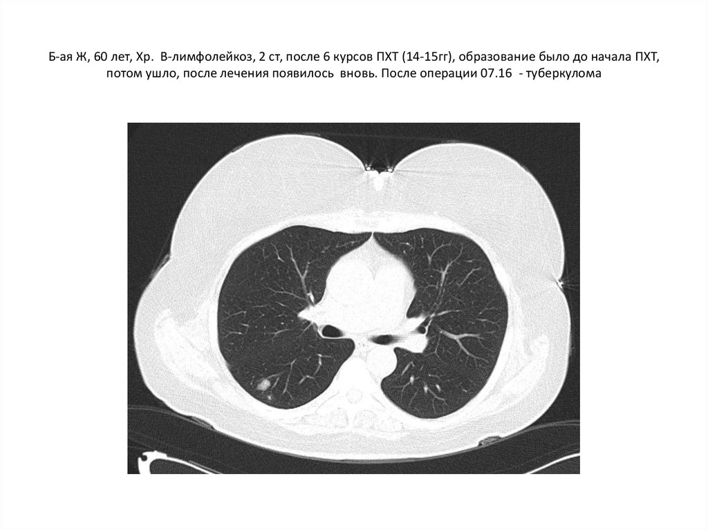 Б-ая Ж, 60 лет, Хр. В-лимфолейкоз, 2 ст, после 6 курсов ПХТ (14-15гг), образование было до начала ПХТ, потом ушло, после