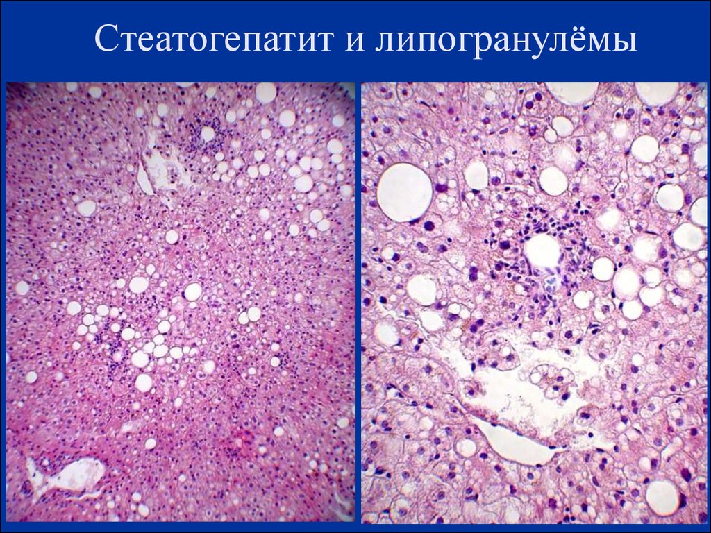 Стеатогепатит. Липогранулемы гистология. Стеатогепатит гистология. Липогранулема молочной железы. Алкогольный стеатогепатит.