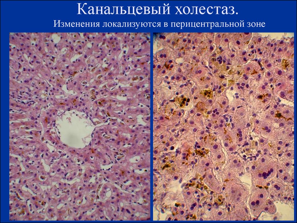 Холестаз что это. Печеночно канальцевый холестаз. Экстралобулярный холестаз.