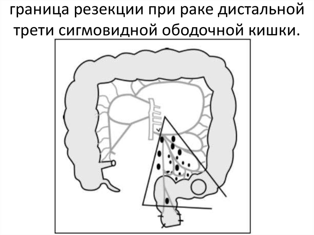 Рак сигмовидной кишки карта вызова смп