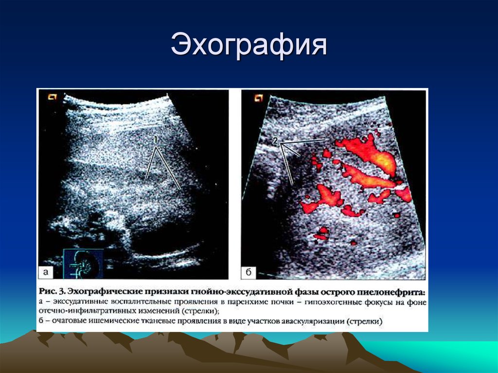 Эхография. Эхографические признаки пиелонефрита. УЗИ эхография. Ультразвуковые признаки острого пиелонефрита.