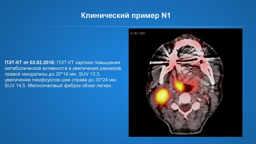 Метаболическая активность на пэт кт что это