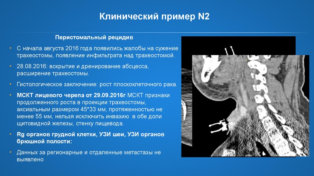 Полный рецидив