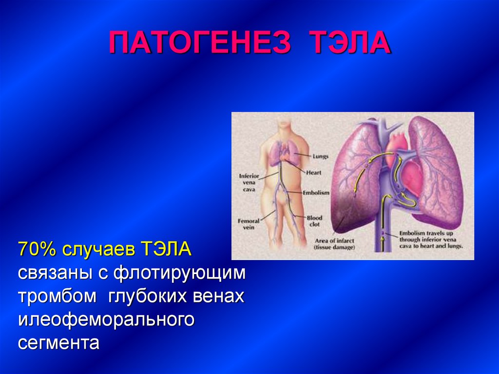 Тромбоэмболия легочной артерии презентация