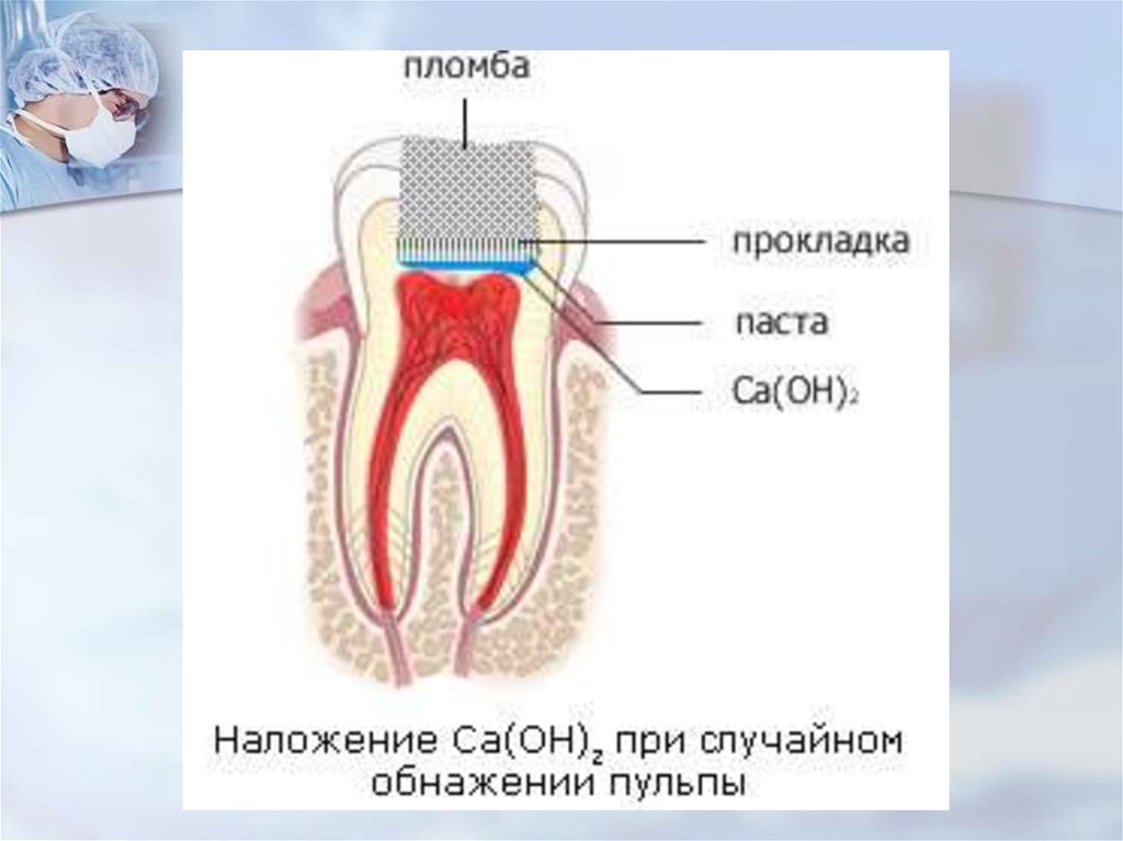 Схема наложения лечебных прокладок