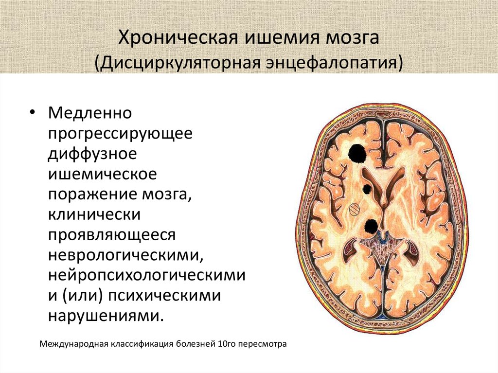 Хроническая ишемия мозга 1. Хроническая ишемия головного мозга. Дисциркуляторная энцефалопатия головного мозга. Иш имия головного мозга. Ишемическое поражение мозга.