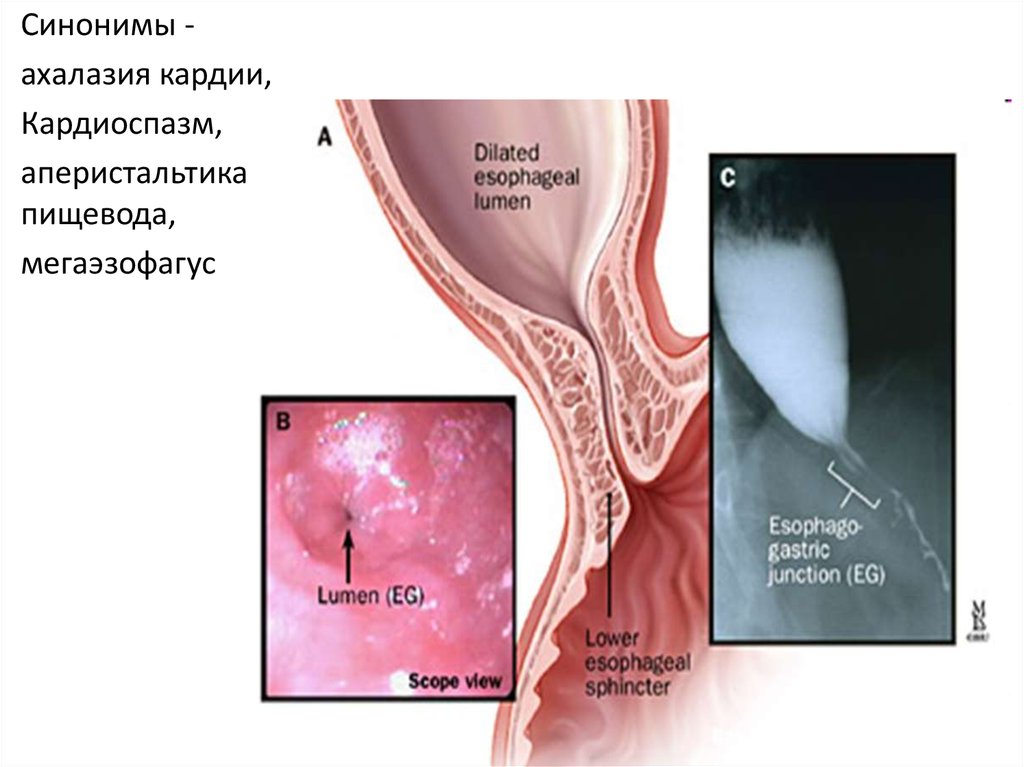 Причины кардии. Халазия и ахалазия кардии. Ахалазия пищевода эзофагоскопия. Степени ахалазии кардии на рентгене. Ахалазия кардии манометрия.
