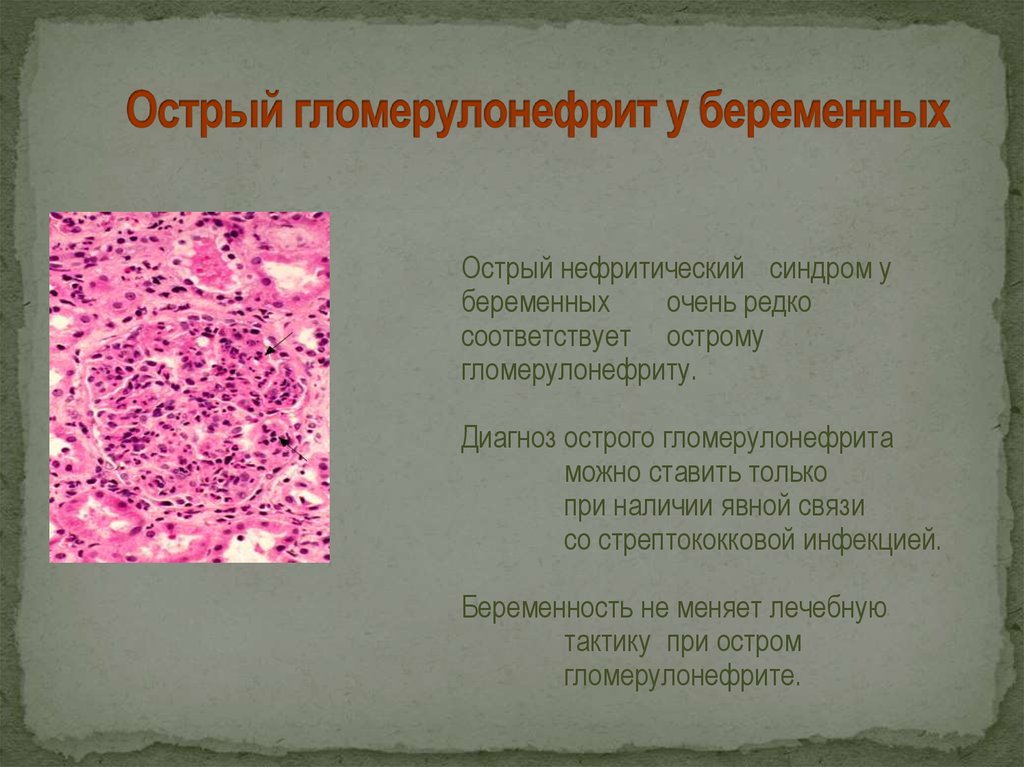 Острый постстрептококковый гломерулонефрит у детей