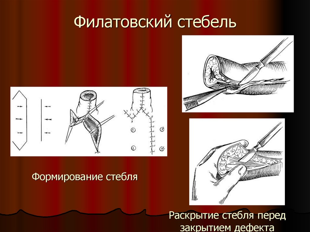 Филатовский стебель презентация