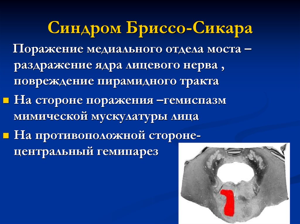 Синдром мийяра гюблера. Бриссо Сикара. Синдром Бриссо. Паралич Бриссо-Сикара.