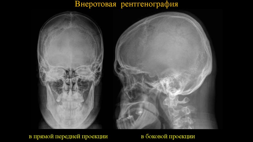 Проекции рентгенограмм. Рентгенография нижней челюсти в прямой проекции. Рентген боковой проекции челюсти. Рентген черепа в боковой проекции.