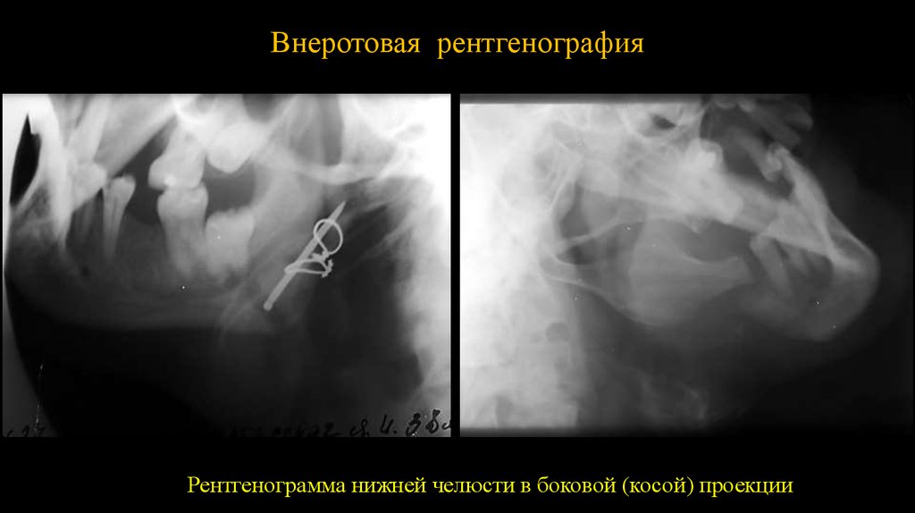 Проекция челюсти. Внеротовая рентгенография нижней челюсти. Рентген нижней челюсти в боковой. Внеротовая (экстраоральная) рентгенография. Снимок нижней челюсти в косой проекции.