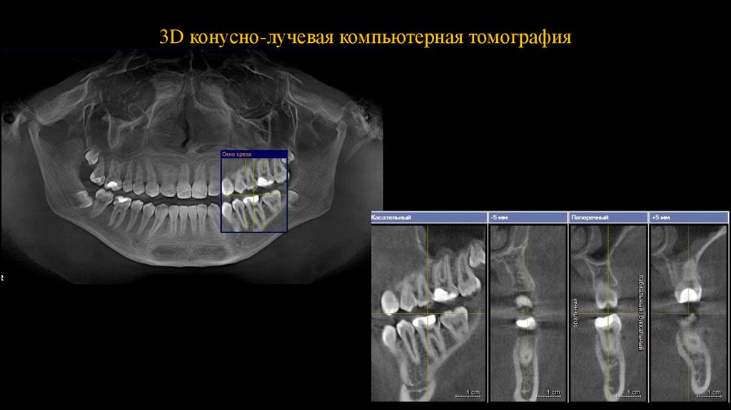 Клкт в стоматологии. Конусно-лучевая компьютерная томография (КЛКТ). Конусно-лучевая компьютерная томография челюстно-лицевой области. Конусно лучевая компьютерная томограмма. КЛКТ 5x5.