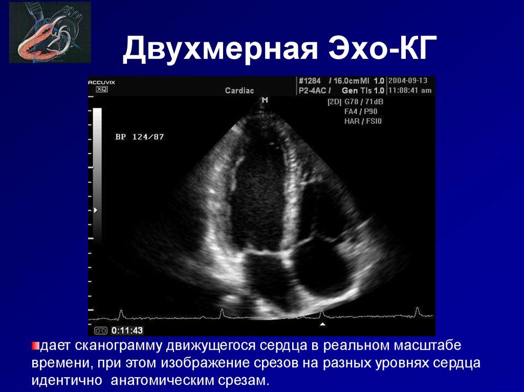 Какой эхо. Анатомия сердце эхокардиография. Правый желудочек ЭХОКГ. Двухмерная ЭХОКГ. Анатомия сердца на ЭХОКГ.