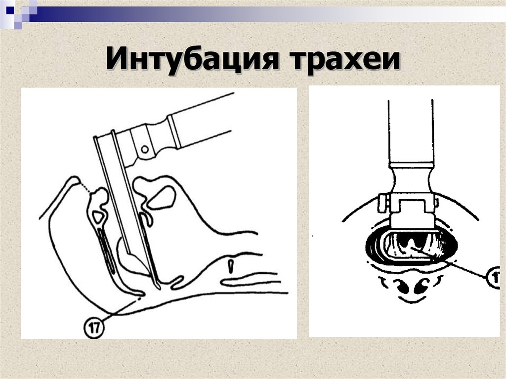 Интубация трахеи. Альтернативные методы интубации трахеи. Проводник при интубации трахеи. Интубация трахеи схема.