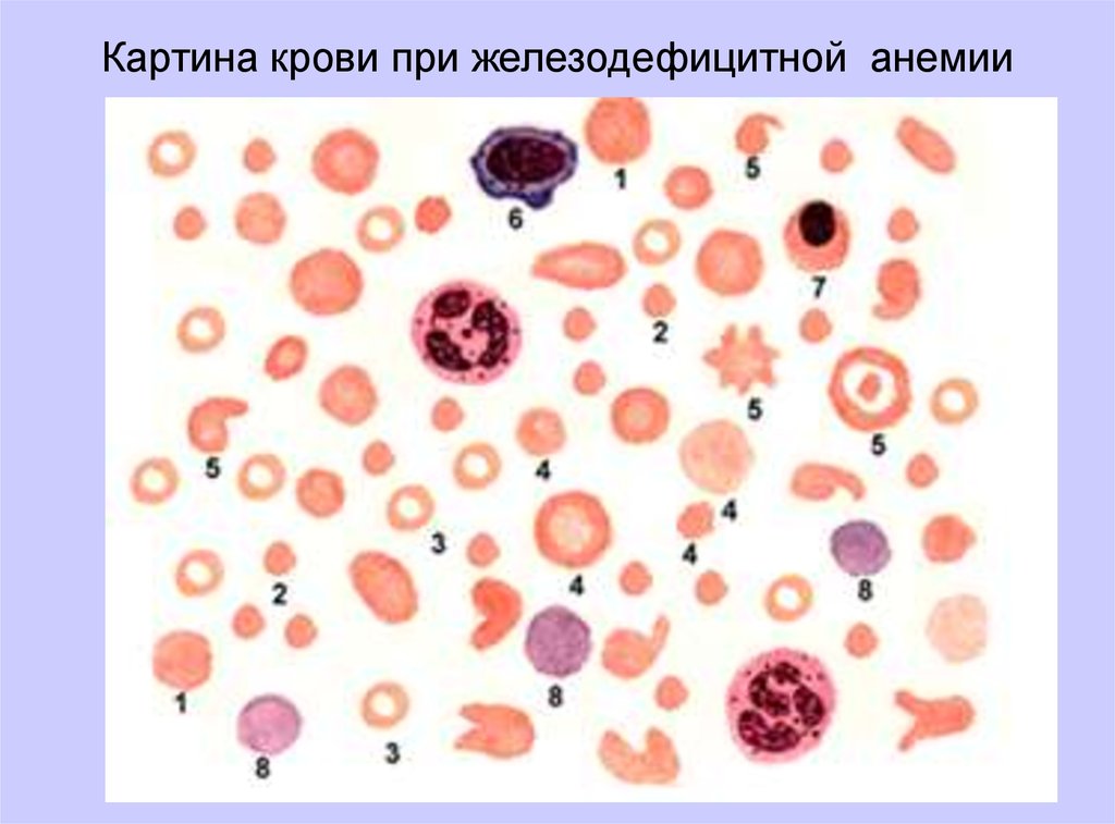 Для железодефицитной анемии характерна такая картина периферической крови