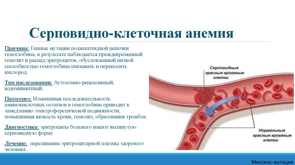 Серповидноклеточная анемия какая