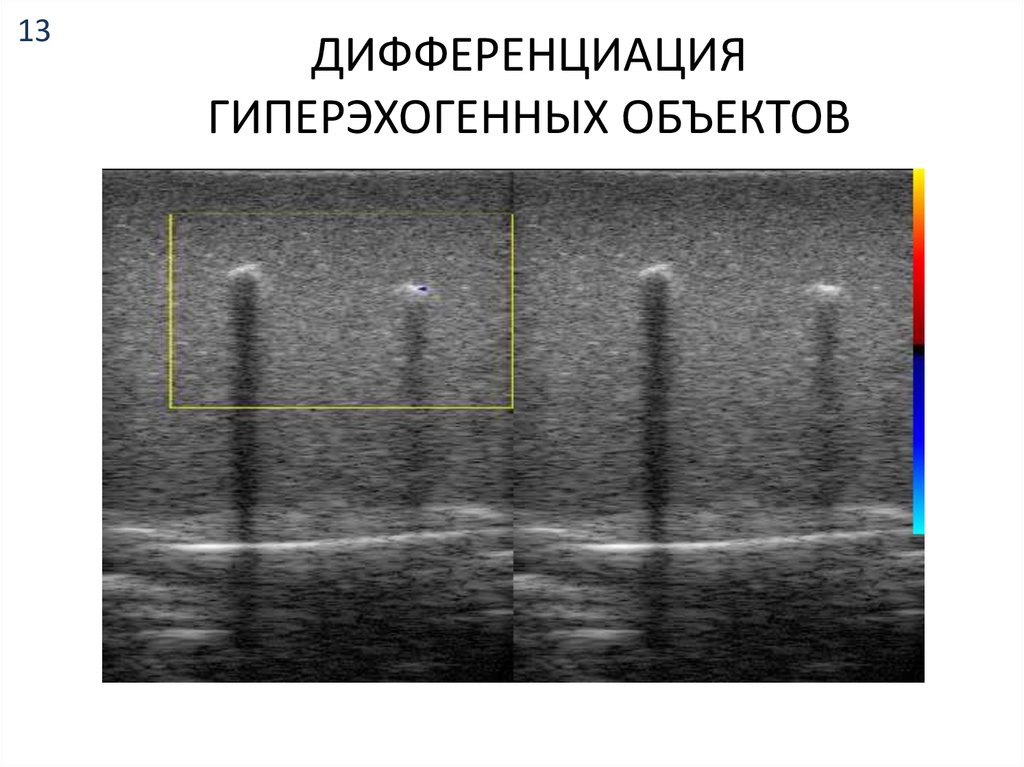 Гиперэхогенный фокус. Гиперэхогенные островки веерообразные тени. Гиперэхогенное образование на створках аортального клапана.