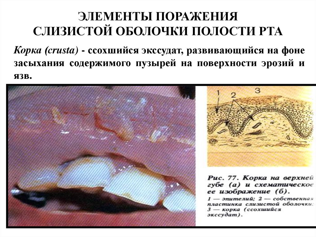 Слизистая оболочка полости рта фото