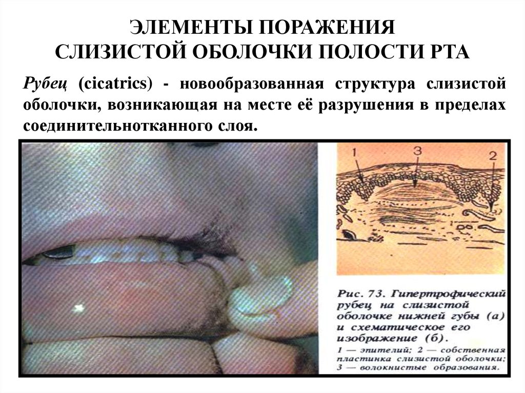 Слизистая оболочка полости рта фото