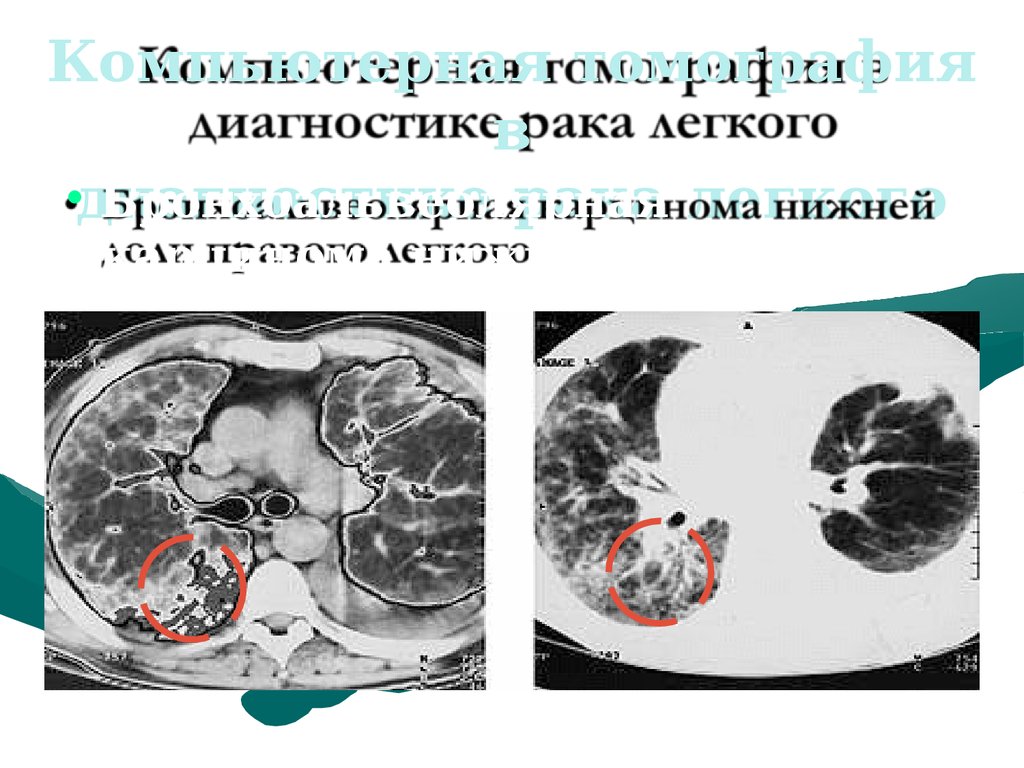 Легкие диагнозы. Мрт при онкологии легких. Кт диагностика легких. Кт-плотность метастаз в легких.