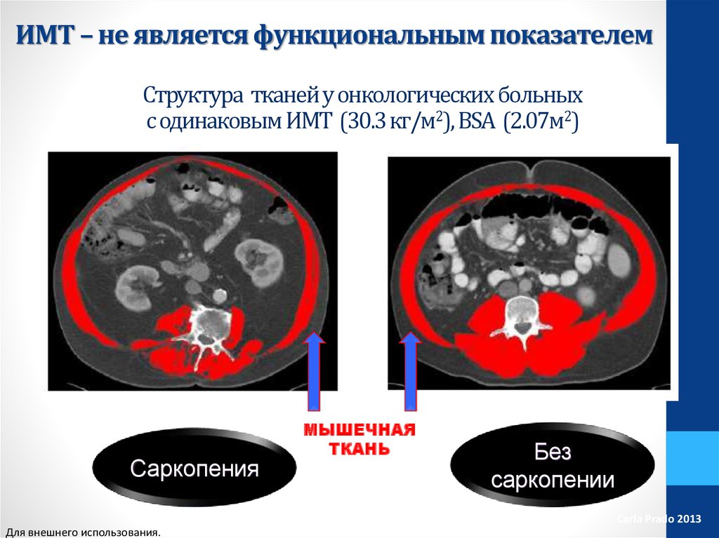 Что не является функциональным. Саркопения презентация. Факторы риска саркопении. Первичная и вторичная саркопения. Старческая саркопения.