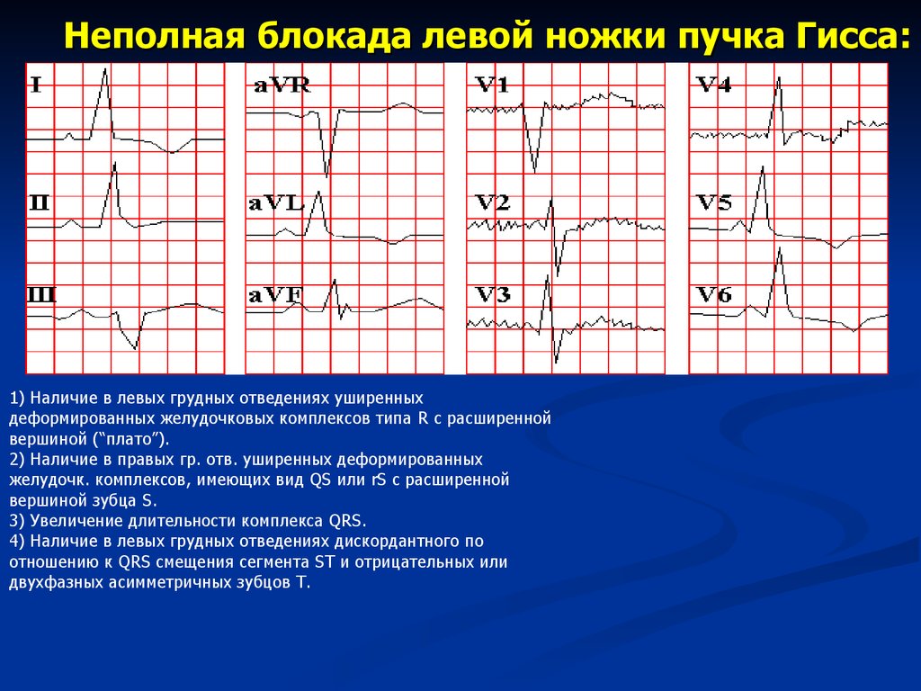 Неполная блокада гиса на экг. Неполная блокада левой ножки пучка Гиса на ЭКГ. ЭКГ блокада левой ножки пучка. Признаки неполной блокады левой ножки пучка Гиса на ЭКГ. ЭКГ признаки при неполной блокаде левой ножки пучка Гиса.