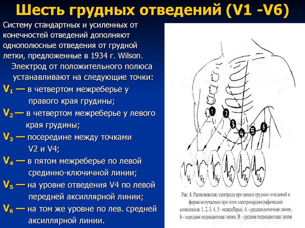 На левую руку при экг накладывают. При записи ЭКГ грудной v6 электрод. При записи ЭКГ грудной v3 электрод располагается:. Грудные отведения на ЭКГ электроды. При записи ЭКГ грудной v5 электрод располагается.