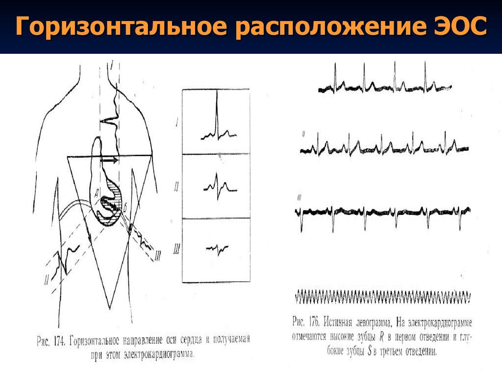 Вертикальная эос. Горизонтальное расположение ЭОС на ЭКГ. Горизонтальному положению электрической оси сердца соответствует. Горизонтальное положение ЭОС на ЭКГ. ЭКГ положение электрической оси полугоризонтальное.