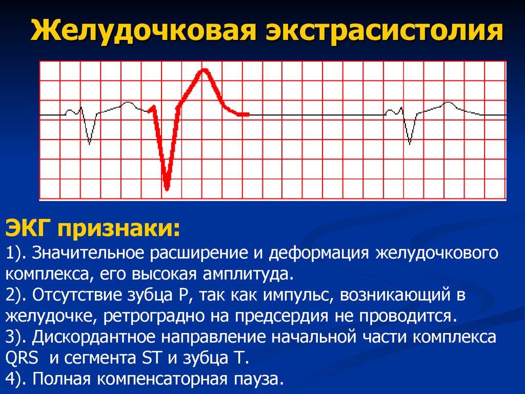 Экстрасистола желудочков