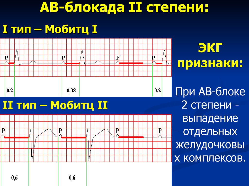 Блокада на первом. Атриовентрикулярная блокада Мобиц 1 ЭКГ. Неполная АВ блокада 1 степени на ЭКГ. АВ блокада 3 на ЭКГ. АВ блокада 1 степени на ЭКГ.