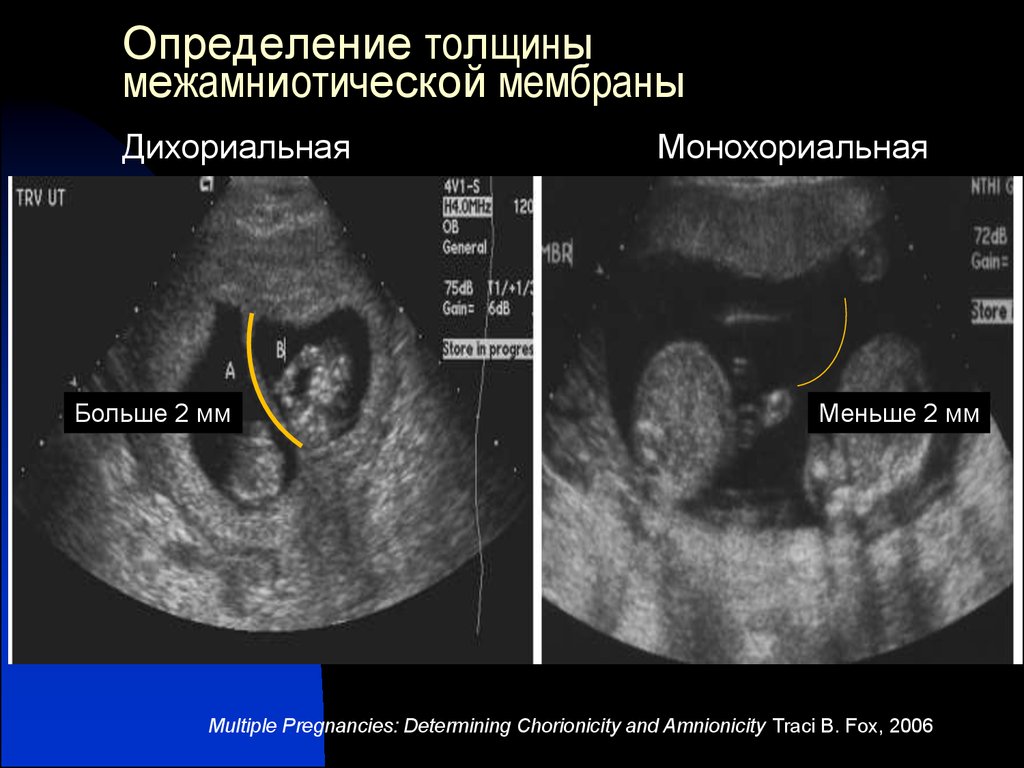 Монохориальная двойня. УЗИ признаки монохориальной двойни. Дихориальная и монохориальная. Дихориальная диамниотическая двойня УЗИ. УЗИ моноамниотической двойне.