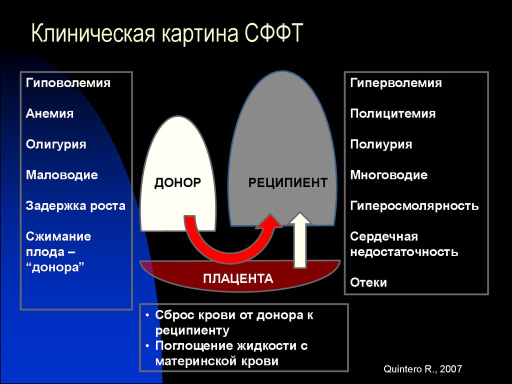 Фето фетальный трансфузионный синдром. Гиперосмолярность. Синдром фето-фетальной трансфузии клинические рекомендации. Клиническая картина гиперволемия и гиповолемия. Коррекции СФФТ.